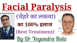 Facial Paralysis (Bell,s Palsy ) ka complete treatment in hindi by Dr Yogendra Bola । चेहरे का लकवा