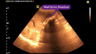 Wall-Echo-Shadow Or Double Arc-Shadow Sign | Focal fat sparing of the liver