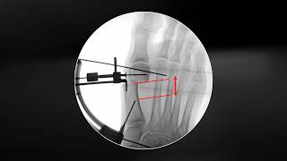 Building Confidence in MIS Bunion Surgery: Practical Tips, Key Landmarks, and Fluoroscopy Views
In this video, we explore practical minimally invasive bunion surgery tips designed to help surgeons improve accuracy, reduce complications, and shorten the learning curve associated with minimally invasive bunion surgery.
This comprehensive walkthrough highlights key technical steps, anatomical landmarks, and fluoroscopic strategies for achieving optimal outcomes in hallux valgus correction.
The minimally invasive surgery (MIS) bunionectomy technique offers a minimally invasive approach to correcting bunion deformity through controlled osteotomy, translation, and fixation of the first metatarsal. However, mastering this procedure can require significant experience, with early adopters historically needing 30–50 cases to gain confidence. With guided instrumentation, this learning curve can be reduced to approximately 15–20 cases, improving adoption and consistency.
A major focus of this video is patient positioning and fluoroscopy optimization, both of which are critical for precise wire placement and osteotomy execution. Proper foot positioning, including slight declination of the first metatarsal, allows for improved visualization of the first tarsometatarsal (TMT) joint and reduces the need for excessive fluoroscopy.
The video also highlights key anatomical landmarks and preoperative marking techniques that help guide wire trajectory and surgical accuracy. Understanding the correct entry points and alignment relative to the first metatarsal axis is essential for avoiding common pitfalls such as wire skiving or improper fixation.
A core component of the technique is the osteotomy itself. Surgeons are guided to perform a precise first metatarsal osteotomy along the long axis of the bone while maintaining correct orientation in both AP and lateral views. Proper execution ensures optimal alignment and positioning of the capital fragment.
The use of a guided translation system is another critical advantage of this approach. By carefully controlling the lateral translation and rotation of the capital fragment, surgeons can achieve effective correction of the intermetatarsal angle and sesamoid realignment, restoring normal biomechanics of the foot.
Fluoroscopy plays a vital role throughout the procedure, enabling real-time confirmation of wire placement, osteotomy alignment, and final fixation. Strategic imaging techniques reduce radiation exposure while improving surgical precision.
The final stages of the procedure involve secure fixation using screws placed through guided instrumentation. Proper sequencing—stabilizing the proximal fragment first before drilling additional fixation—helps maintain correction and prevents loss of alignment.
This video is ideal for orthopedic surgeons and trainees looking to enhance their skills in MIS bunion surgery and develop confidence in performing consistent, accurate corrections using modern instrumentation and imaging guidance.
👇 Helpful Arthrex Reference Links:
https://www.arthrex.com/foot-ankle/chevron-osteotomy?utm_source=youtube&utm_medium=video_description&utm_campaign=corp_foot_ankle&utm_content=gTEz2WlNfu8_surgical_technique
https://www.arthrex.com?utm_source=youtube&utm_medium=video_description&utm_campaign=corp_foot_ankle&utm_content=gTEz2WlNfu8_surgical_technique
👍 Like, comment, and subscribe to see more patient success stories and innovations in minimally invasive orthopedic procedures.
Arthrex is a global leader in orthopedic surgical innovation, dedicated to advancing minimally invasive techniques and medical education. Our mission is to help surgeons treat their patients better by providing cutting-edge products, expert training, and comprehensive resources for orthopedic procedures, including sports medicine, joint preservation, and trauma care.
Stay Connected: 👍 Subscribe to our channel for the latest in orthopedic surgical techniques and product updates.
📱 Follow Arthrex on:
LinkedIn: / https://www.linkedin.com/company/arthrex/
Facebook: / https://www.facebook.com/Arthrex/
Instagram: / https://www.instagram.com/arthrexmeded/
X: https://x.com/arthrex Building Confidence in MIS Bunion Surgery: Practical Tips, Key Landmarks, and Fluoroscopy Views