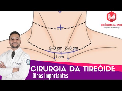 Vídeo: 3 maneiras de esconder uma cicatriz de tireoidectomia