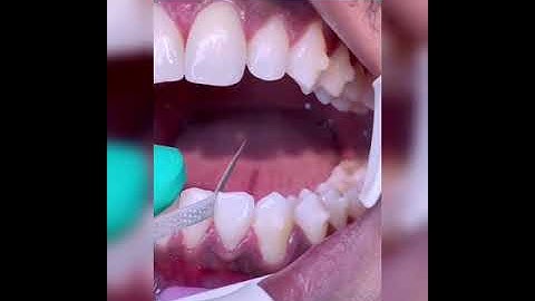 Mài kẽ răng I Nha Khoa Smile HT #shorts
