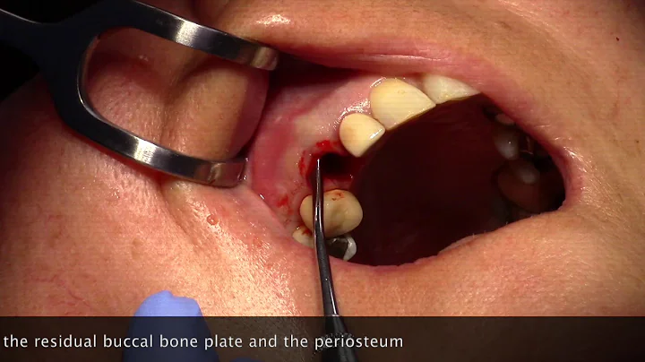 Alveolar Ridge Preservation Technique or Socket Gr...
