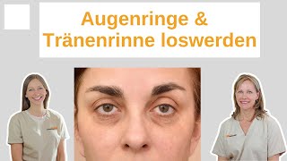 Augenringe & Tränenrinne mit Hyaluron loswerden