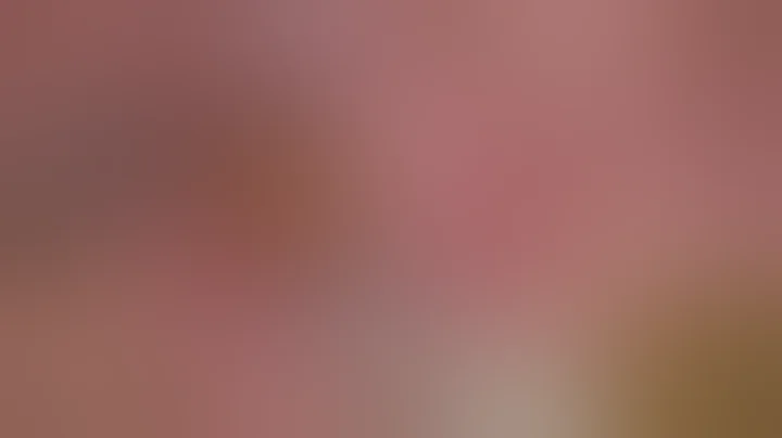 IOL Exchange with Sutureless Scleral Fixation (Sin...