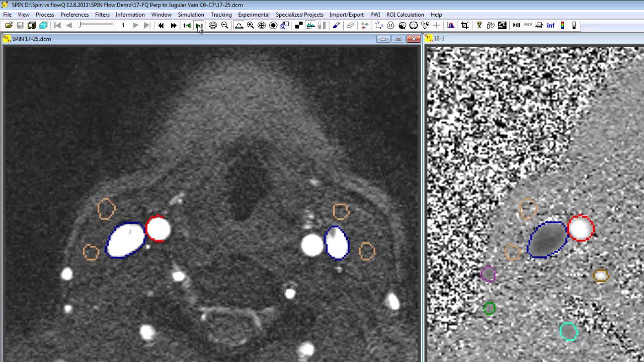 Flow quantification using SPIN software