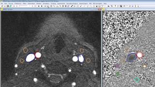Flow quantification using SPIN software Profile