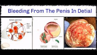 What is this!! Blood comes out of the penis. Don't be upset, know the causes and treatment