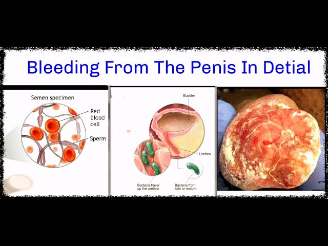 What is this!! Blood comes out of the penis. Don't be upset, know the  causes and treatment 