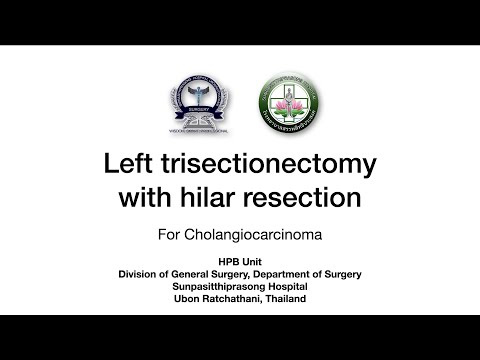 Left trisectionectomy with hilar resection for perihilar CCA, an UNCUT video clip with speed 2.0x.