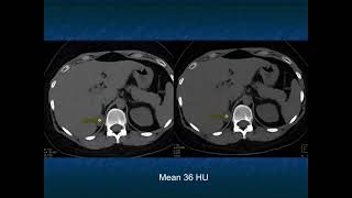 CT of the Large Adrenal Mass: Follow, Biopsy, Resect - Part 1