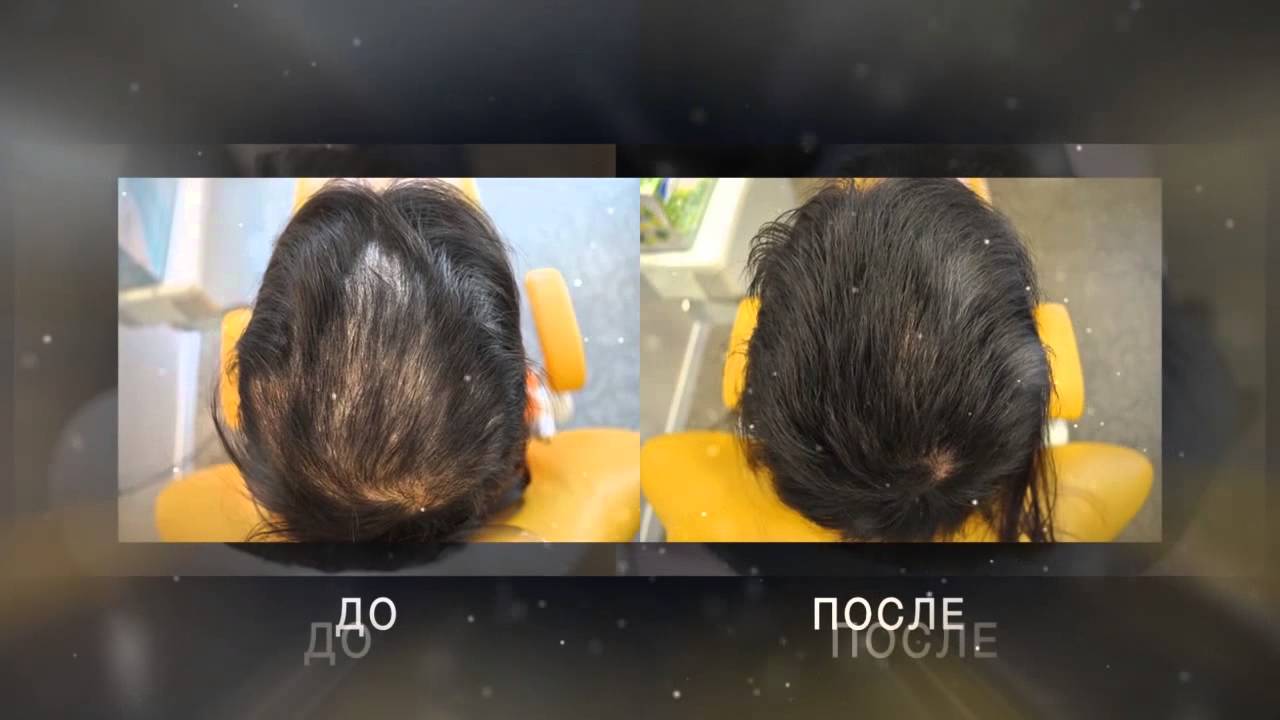 лечение выпадения волос - YouTube