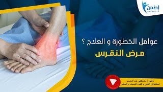 مرض النقرس . ما هي عوامل الخطورة و طرق العلاج ؟