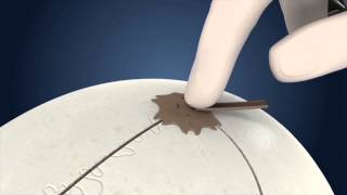 NEOS SURGERY