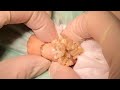 粉瘤 右後頸部 くりぬき法 atheroma, epidermal cyst【アイシークリニック】