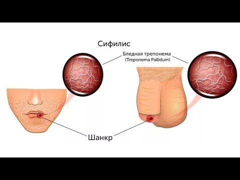 Алокаи чинси ва бемории Сифилис.