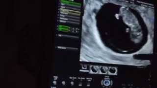 Ten Week Ultrasound Baby 2 Movie Moments