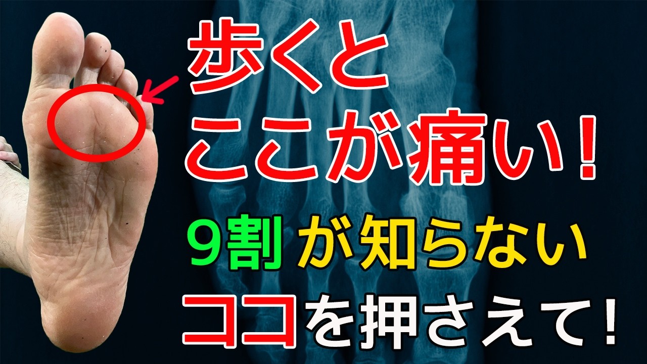 【モートン病】歩くと足の指や足裏の前が痛い・しびれる…モートン病、中足骨頭痛、偏平足の治し方【原因と改善方法】