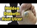 Hidden Diabetic Foot Ulcer