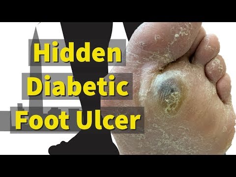 hidden-diabetic-foot-ulcer