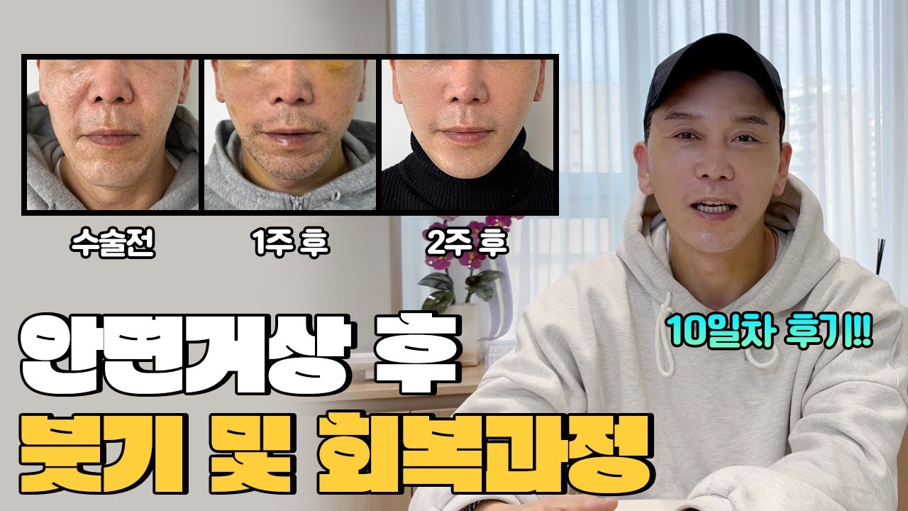 50대남자 안면거상술 10일차 후기 찐경험담 (붓기, 회복과정, 통증, 감각)