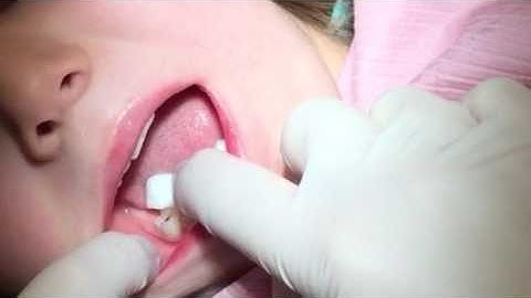 SDF SMART Filling Demo with Advantage Arrest silver diamine fluoride and Fuji GIC