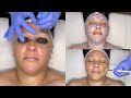 ANTI-AGING FACIAL WITH WET/DRY MICRODERMABRASION FOR NORMAL TO DRY, MATURE, OR SUN-DAMAGED SKIN