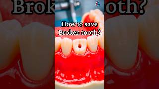 Fixing a Broken  Tooth with a Post, Core Build-Up & Crown