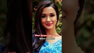 Amy Jackson Before And After Surgery