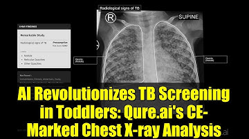AI Revolutionizes TB Screening in Toddlers: Qure.ai