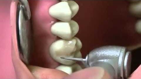 CUSP BUILD UP by Dr Matin Ahmadi