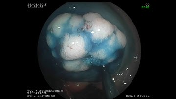 Ascending Colon - LST Granular - Block EMR