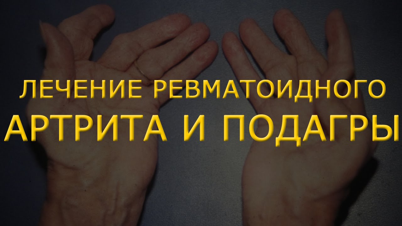 Как и чем лечить ревматоидный артрит и подагру. Эффективное лечение ...