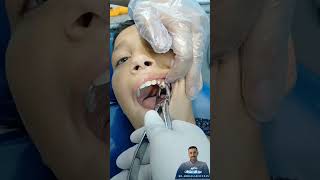 خلع ضرس لبني لطفل ١٠ سنوات دكتور_عبدالله_سلطان_الهنداوي_طبيب_اسنان dr_abdullah_sultandentist