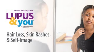 Lupus & You : Hair Loss, Skin Rashes, and SelfImage