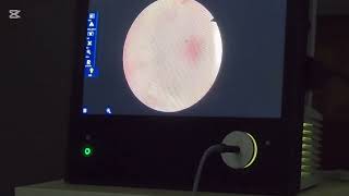 Endoscopic Third Ventriculostomy By Zambian Neurosurgeon Dr Esk 