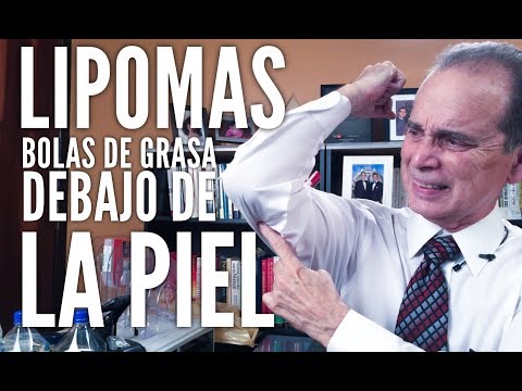 Episodio #1208 Lipomas bolas de grasa debajo de la piel