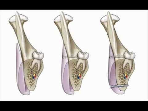 jaw implant surgery mandible implants youtube get a doctors note
