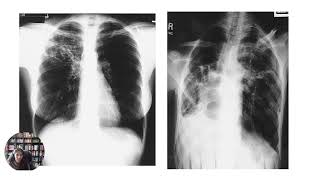 Latent vs Active TB and Clinical Presentation of Active TB