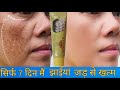 My Fair Cream Complete Review| हिन्दी मैं |My Fair Cream Remove Pigmentation|Melasma And Scars|