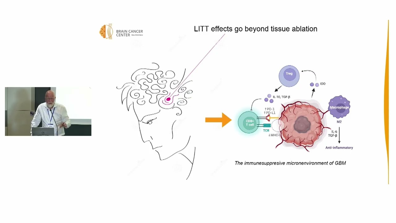 C3 Combination of LITT with Tumor Treating Fields (TTFields) in the treatment of glioblastoma (GBM).