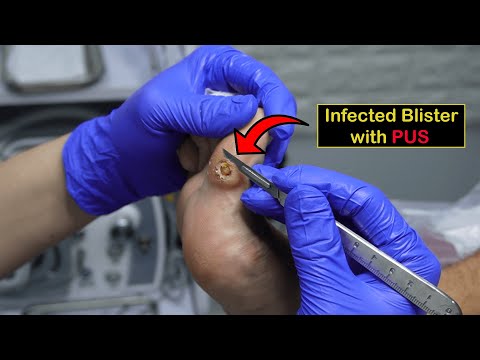Infected Blister POPS during Treatment