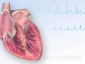 American heart association aha atrial fibrillation animation