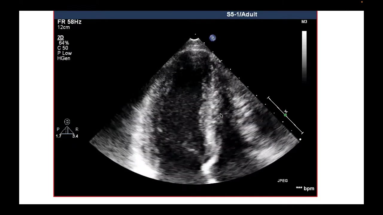 ekokardiyografide apikal pencereler birinci bölüm