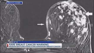 Ohio woman battles rare breast cancer