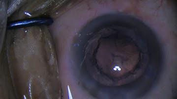 Upgrade zeiss 1FR to lumera I ? routine phacoemulsificaion with omniglo and innovision dslr adapter