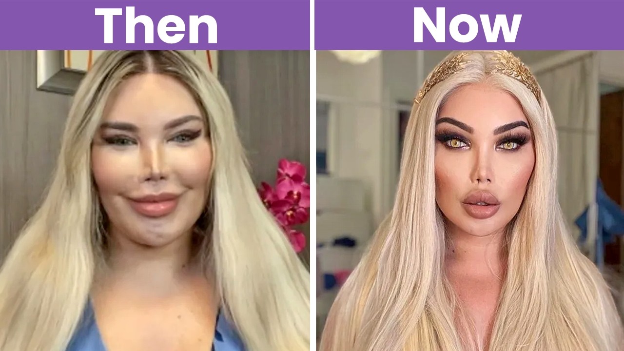 20+ Celebrities Before & After Plastic Surgery (Shocking