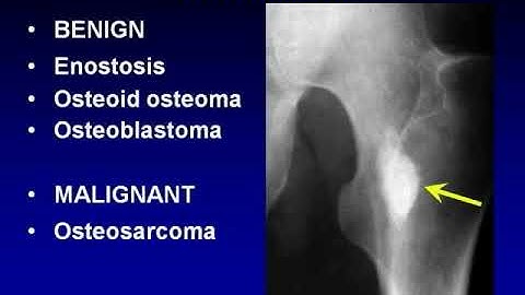 Bone Neoplasms, # Bone
