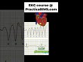 Polymorphic V-tach: Know the Signs & Cardiovert Unstable Patients! #shorts
