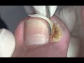 Bad case of ingrown nail