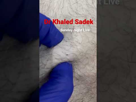 Blackhead extraction join